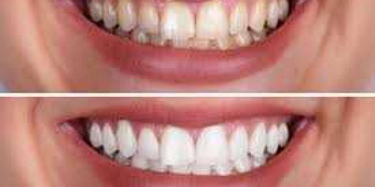 Get a Sparkle! Natural Teeth Whitening Solutions